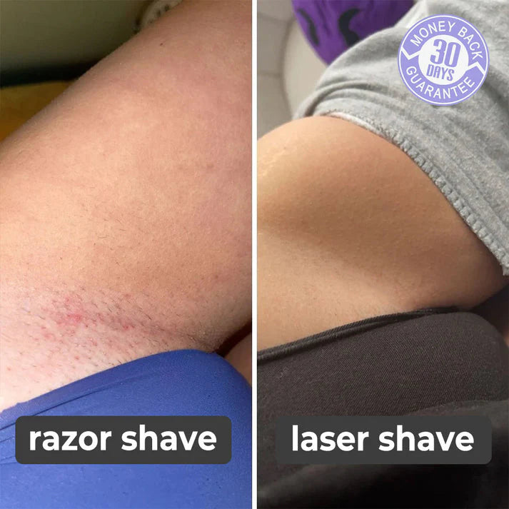 LASER HAIR REMOVER